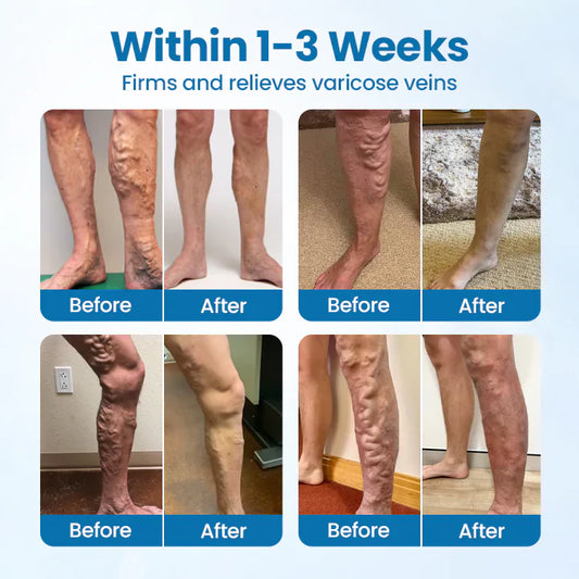 Timilk® VeinGuard Herbal Spray-✅ Clinically proven to eliminate varicose veins in just 7 days!